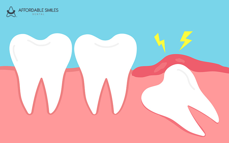 How Long Does It Take to Heal After Wisdom Tooth Extraction in Singapore?