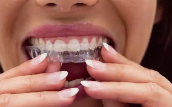 The Rise of Clear Aligners in Singapore's Dental Market