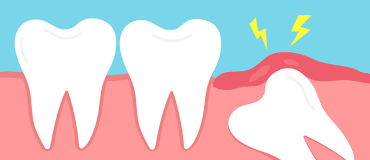 How Long Does It Take to Heal After Wisdom Tooth Extraction in Singapore?