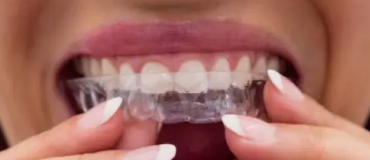 The Rise of Clear Aligners in Singapore's Dental Market