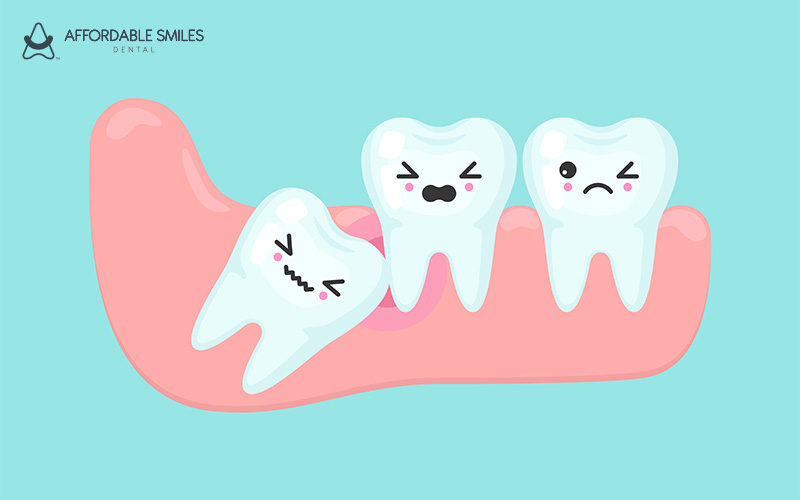 What to Do After Wisdom Tooth Extraction: Recovery Tips for a Smooth Healing Process