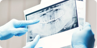 Custom clear aligner designed for patient